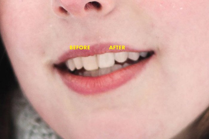 Портрет женского рта модели крупным планом до и после отбеливания зубов в Photoshop